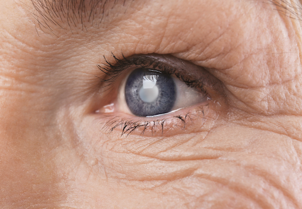 Senior eye with cataracts