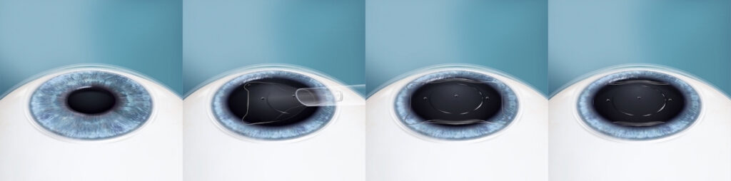 Graphic depicting the EVO ICL procedure on an eyeball