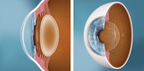 Graphic depicting the STAAR EVO icl procedure